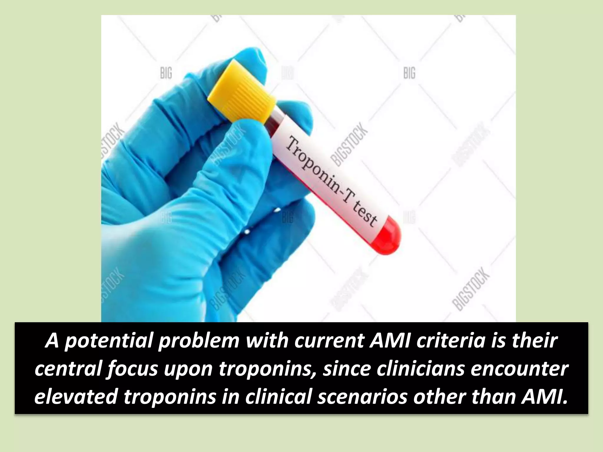 A potential problem with current AMI criteria is their
central focus upon troponins, since clinicians encounter
elevated troponins in clinical scenarios other than AMI.
 
