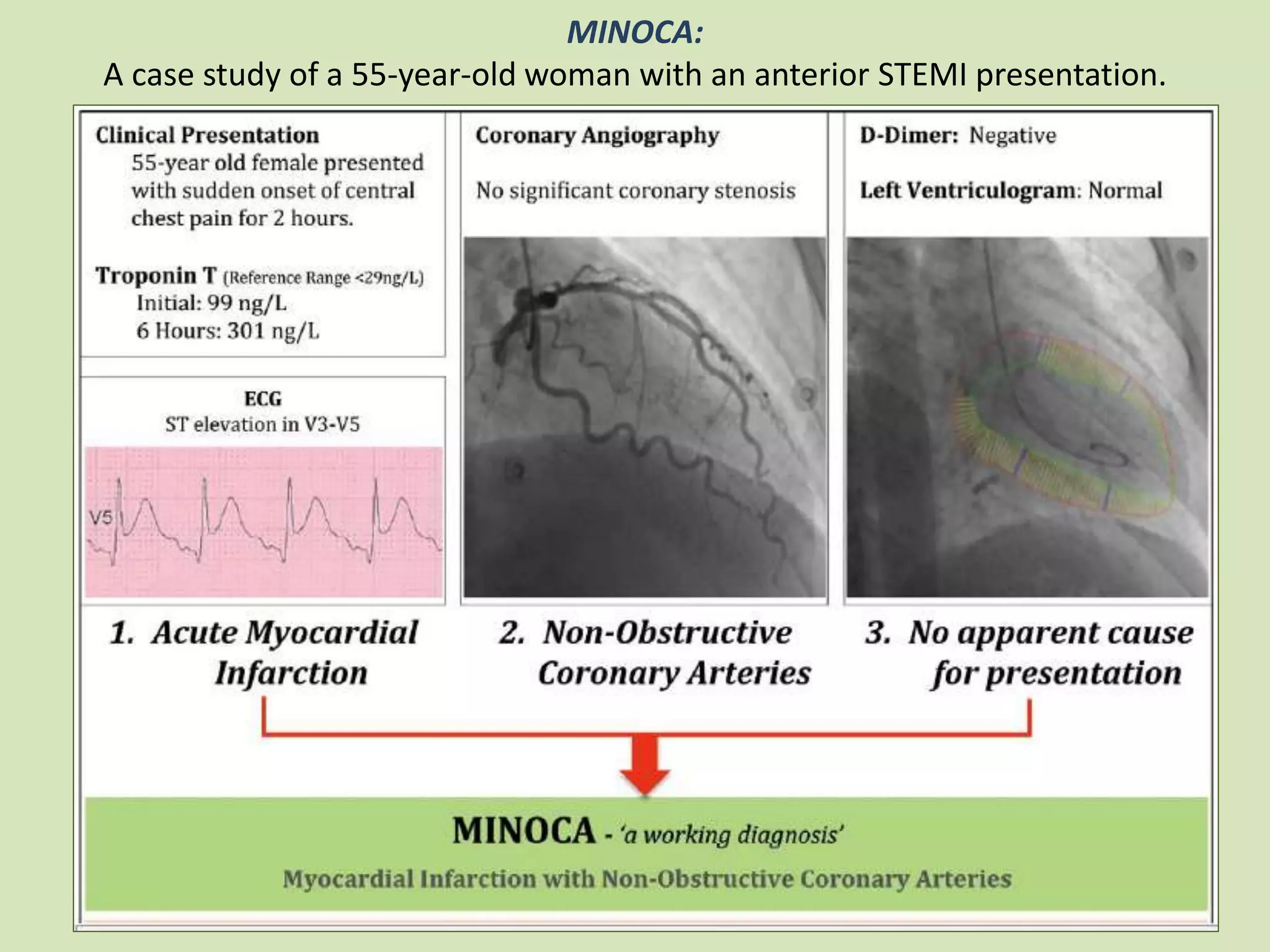 MINOCA:
A case study of a 55-year-old woman with an anterior STEMI presentation.
 