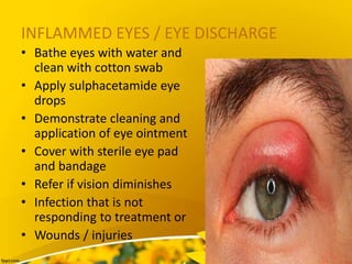 INFLAMMED EYES / EYE DISCHARGE
• Bathe eyes with water and
clean with cotton swab
• Apply sulphacetamide eye
drops
• Demonstrate cleaning and
application of eye ointment
• Cover with sterile eye pad
and bandage
• Refer if vision diminishes
• Infection that is not
responding to treatment or
• Wounds / injuries
 