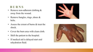 B U R N S
• Remove non-adherent clothing &
away from the wound.
• Remove bangles, rings ,shoes &
belts.
• Assess the extent of burns & treat the
shock.
• Cover the burn area with clean cloth.
• Shift the patient to the hospital.
• If medical aid is delayed start oral
rehydration fluid.
 
