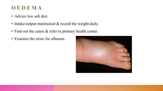 O E D E M A
• Advice low salt diet.
• Intake/output maintained & record the weight daily.
• Find out the cause & refer to primary health center.
• Examine the urine for albumin.
 