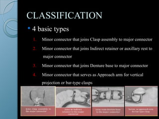 MINOR CONNECTOR-part of cast partial denture | PPTX
