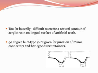  Too far buccally– difficult to create a natural contour of
acrylic resin on lingual surface of artificial teeth.
 90 degree butt-type joint given for junction of minor
connectors and bar-type direct retainers.
 