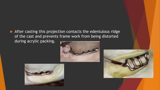 After casting this projection contacts the edentulous ridge
of the cast and prevents frame work from being distorted
during acrylic packing.
 