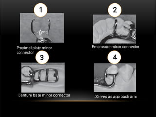 Minor Connector Rpd Types Minor connectors & rests in removable partial denture | PDF