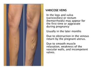 VARICOSE VEINS
In the legs and vulva
(varicosities) or rectum
(hemorrhoids) may appear for
the first time or aggravate
during pregnancy
Usually in the later months
Due to obstruction in the venous
return by the pregnant uterus.
Due to smooth muscle
relaxation, weakness of the
vascular walls, and incompetent
valves.
 