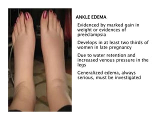 ANKLE EDEMA
Evidenced by marked gain in
weight or evidences of
preeclampsia
Develops in at least two thirds of
women in late pregnancy
Due to water retention and
increased venous pressure in the
legs
Generalized edema, always
serious, must be investigated
 