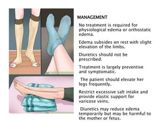 MANAGEMENT
No treatment is required for
physiological edema or orthostatic
edema.
Edema subsides on rest with slight
elevation of the limbs.
Diuretics should not be
prescribed.
Treatment is largely preventive
and symptomatic.
The patient should elevate her
legs frequently.
Restrict excessive salt intake and
provide elastic support for
varicose veins.
Diuretics may reduce edema
temporarily but may be harmful to
the mother or fetus.
 