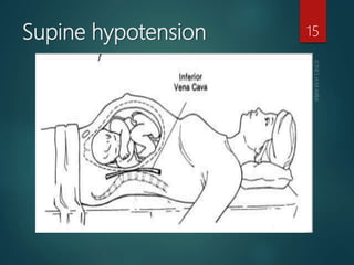 Supine hypotension 15
 