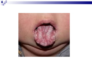 Minor disorders of newborn | PPT