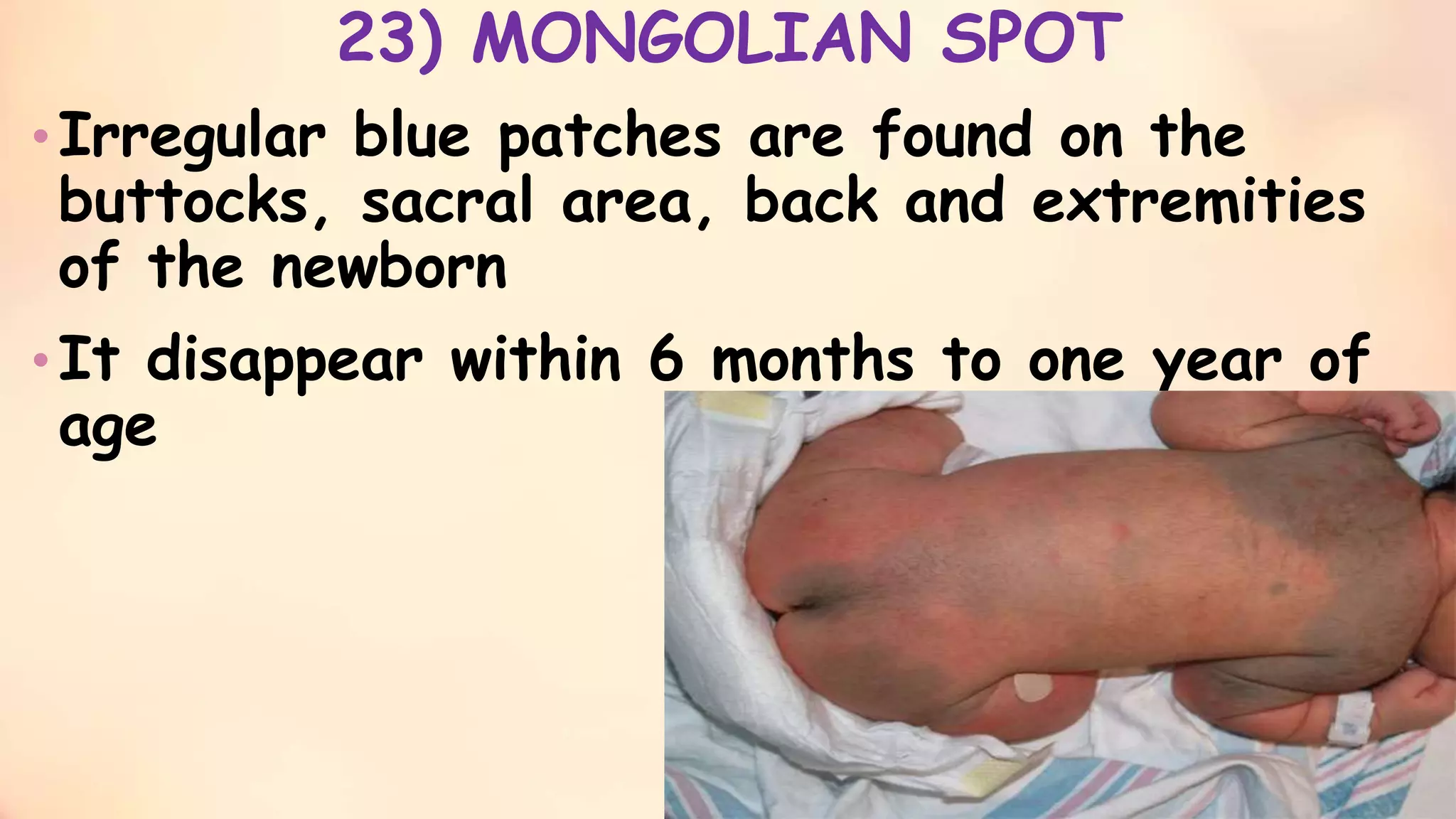 Minor Disorders Of Neonates And Its Management Shani ppt Slideshare 
