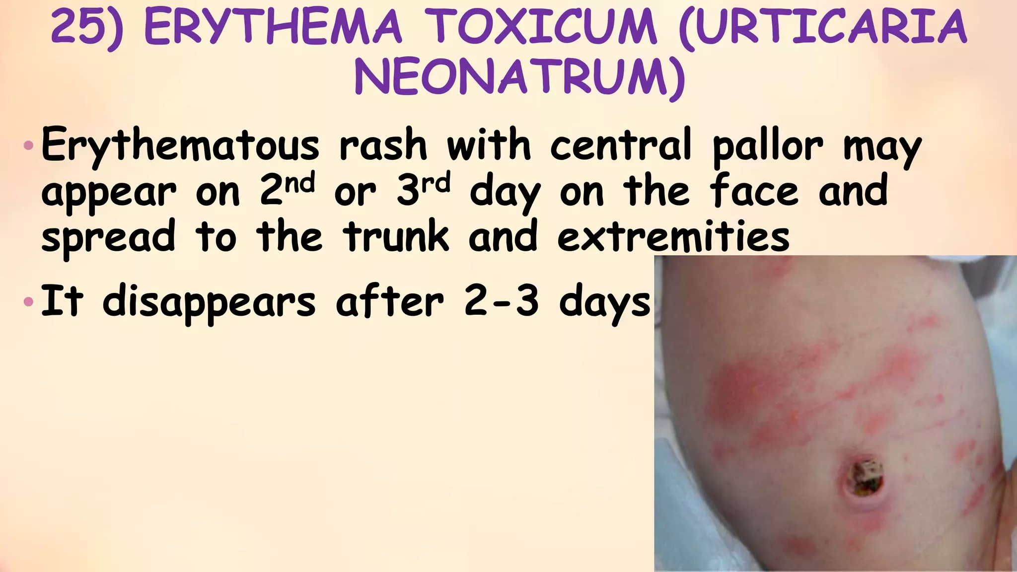 minor disorders of neonates and its management - shani -ppt- slideshare ...