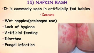 Napkin Rash minor disorders of neonates and its management - shani -ppt- slideshare ...