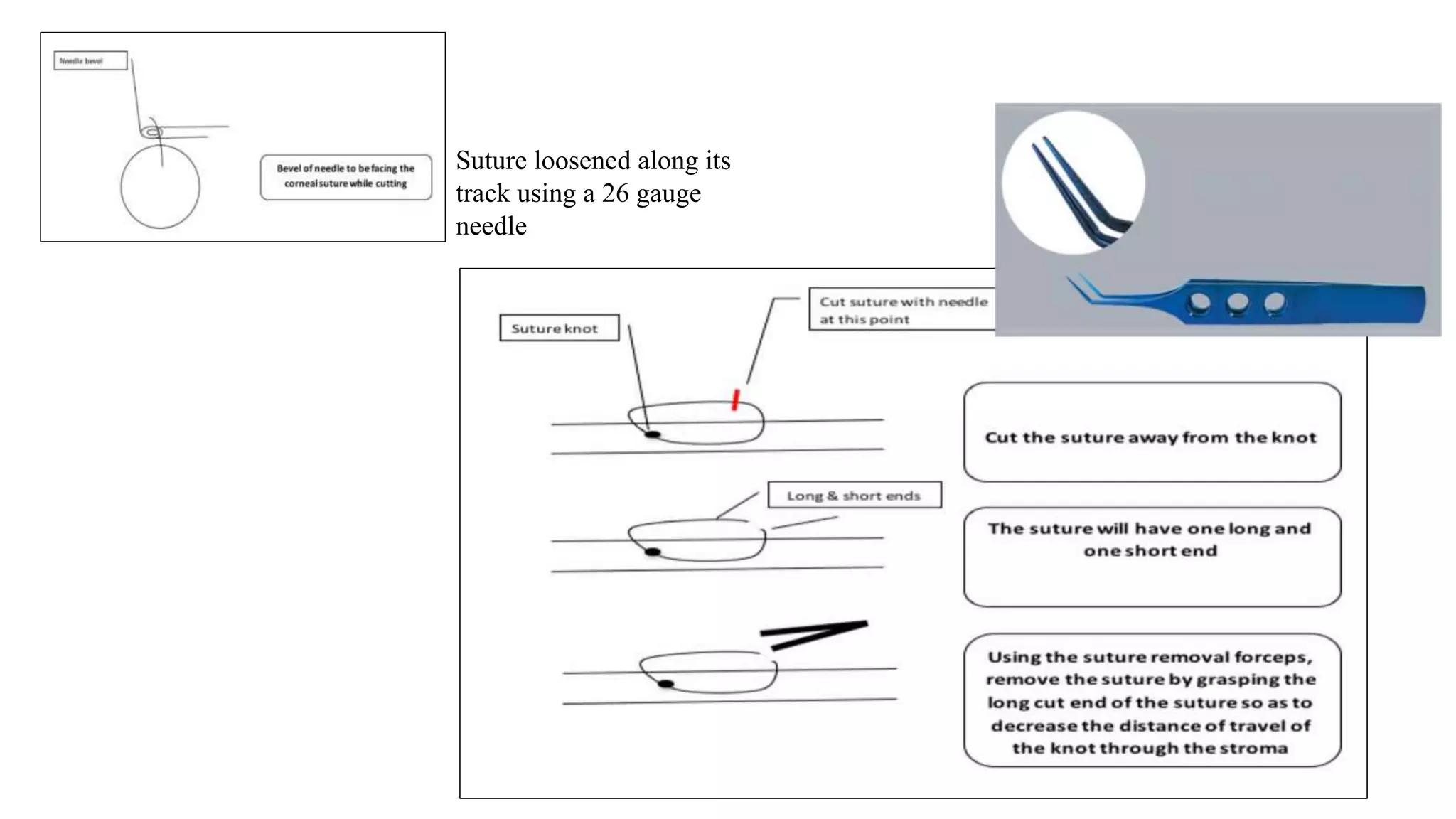 Minor ophthalmic procedures and instruments