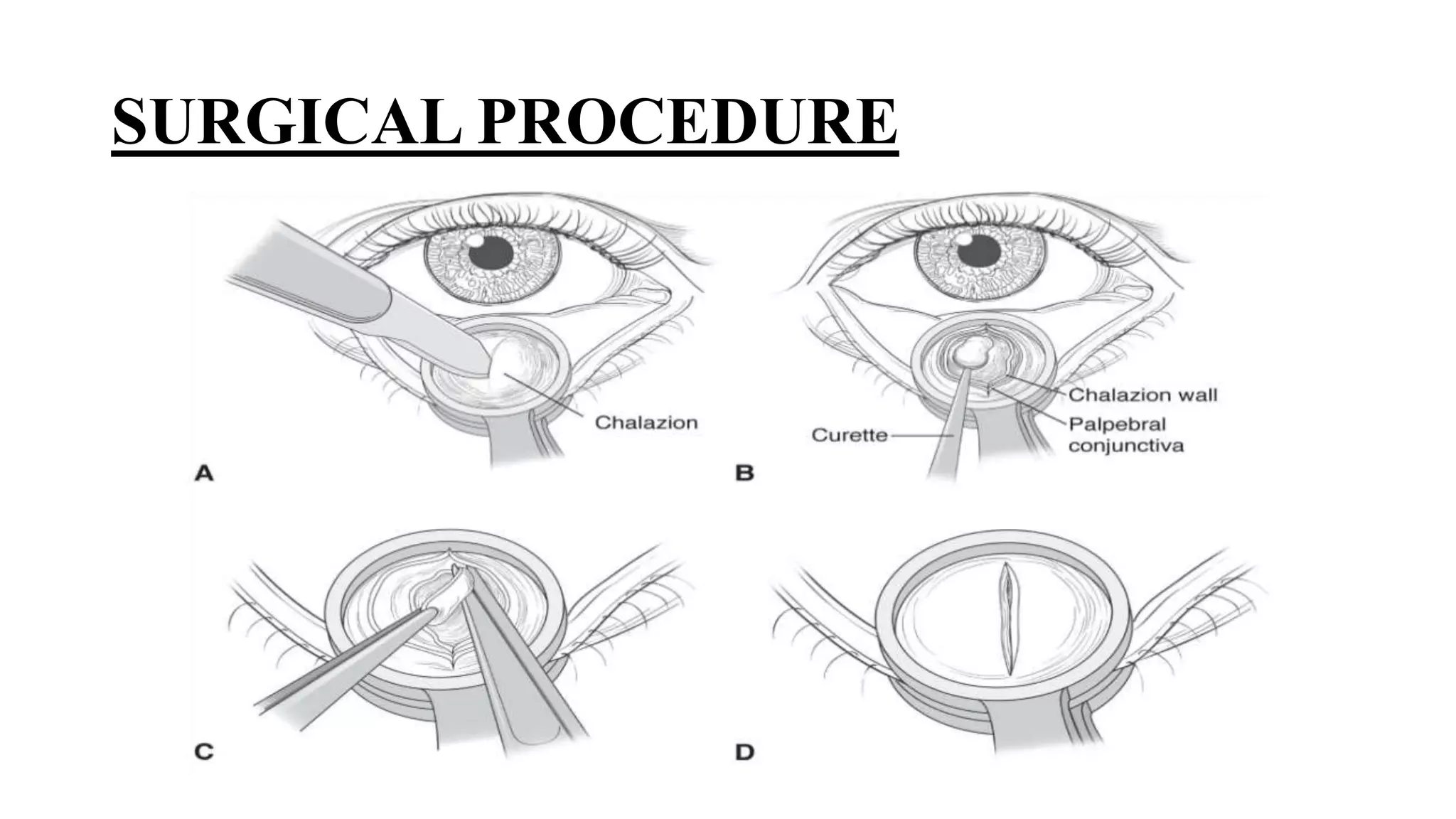 Minor ophthalmic procedures and instruments