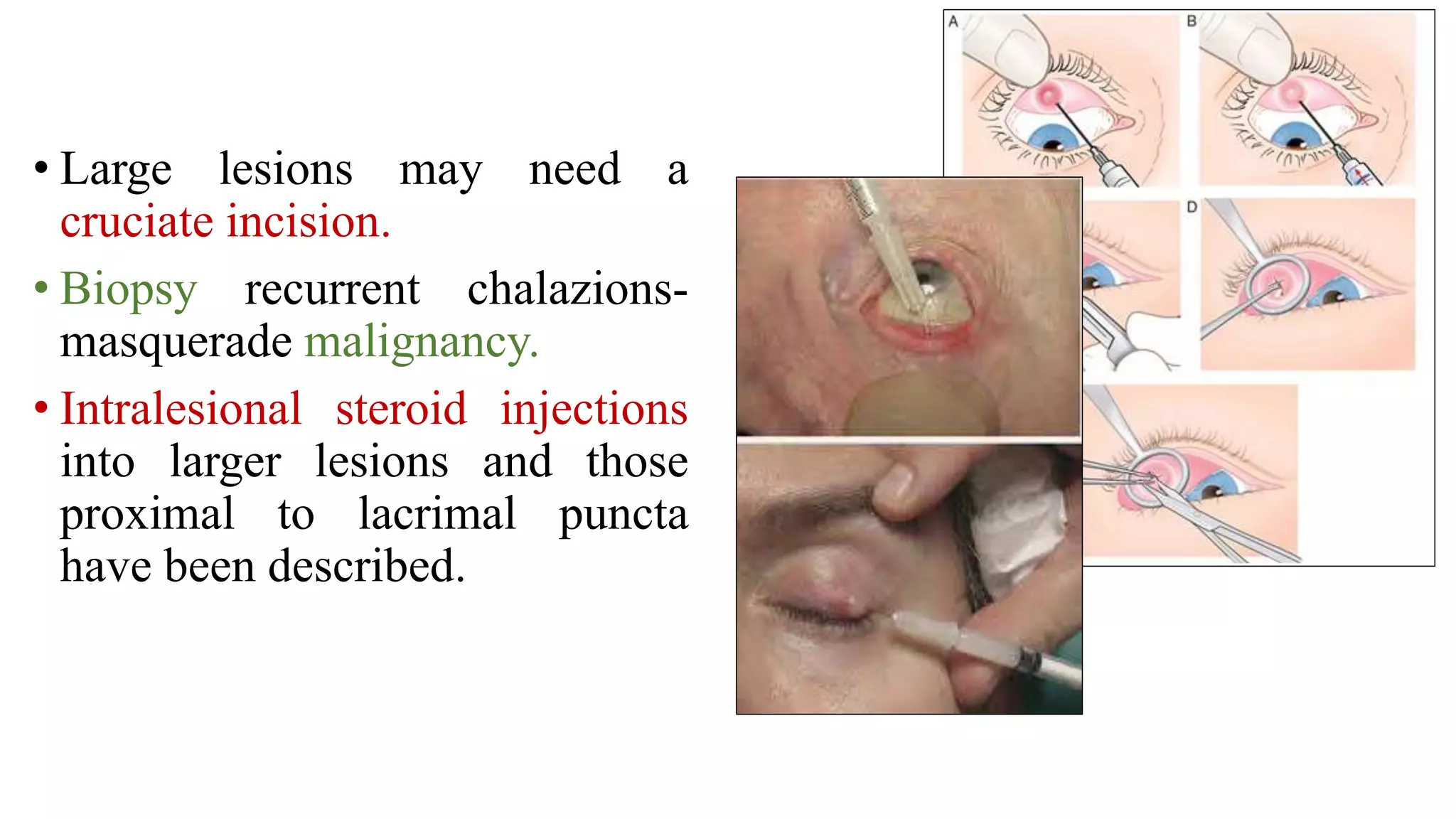 Minor ophthalmic procedures and instruments