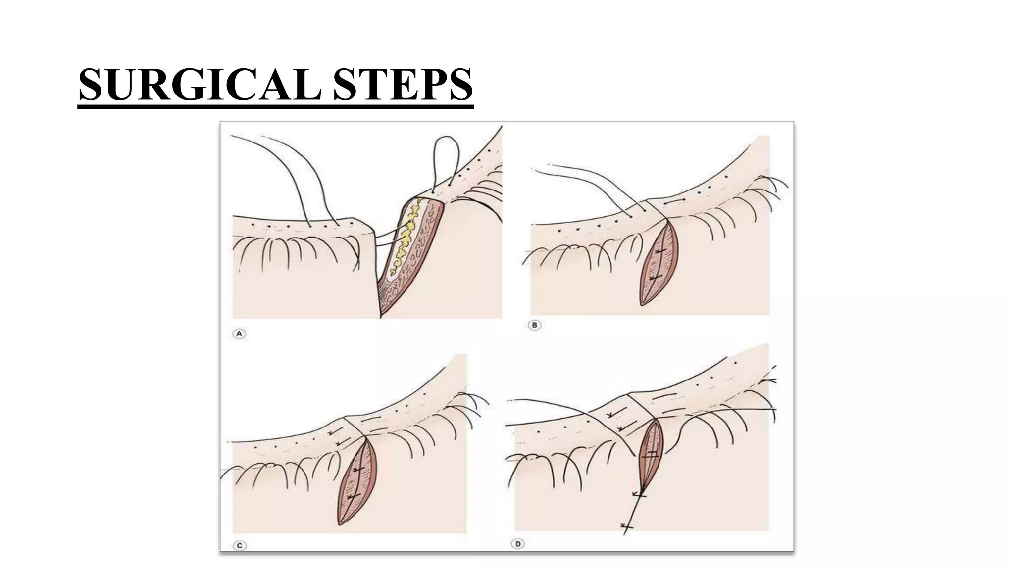 Minor ophthalmic procedures and instruments