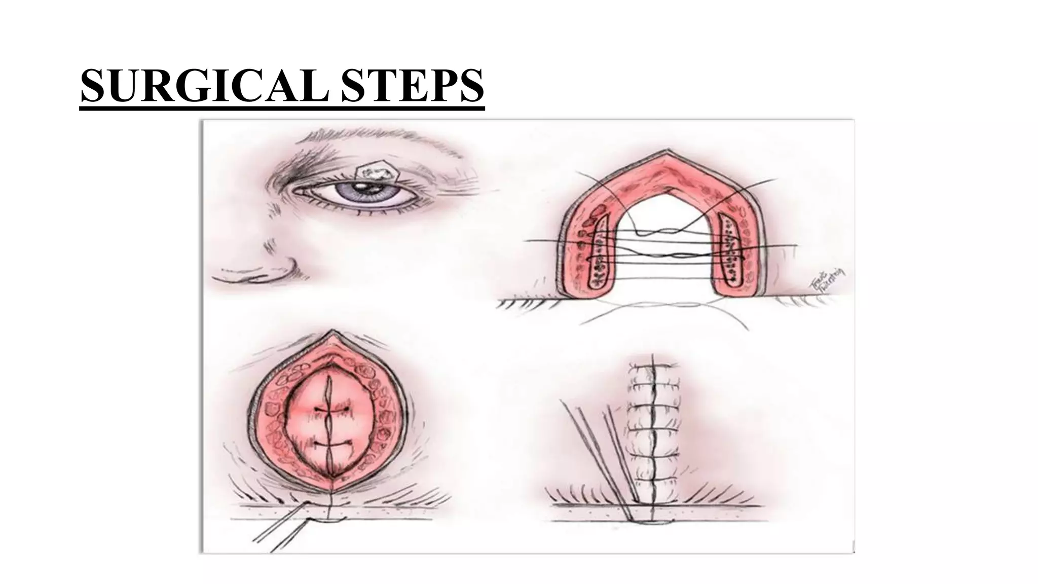 Minor ophthalmic procedures and instruments