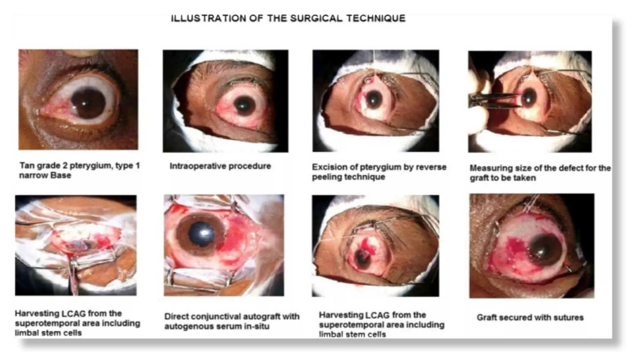 Minor ophthalmic procedures and instruments