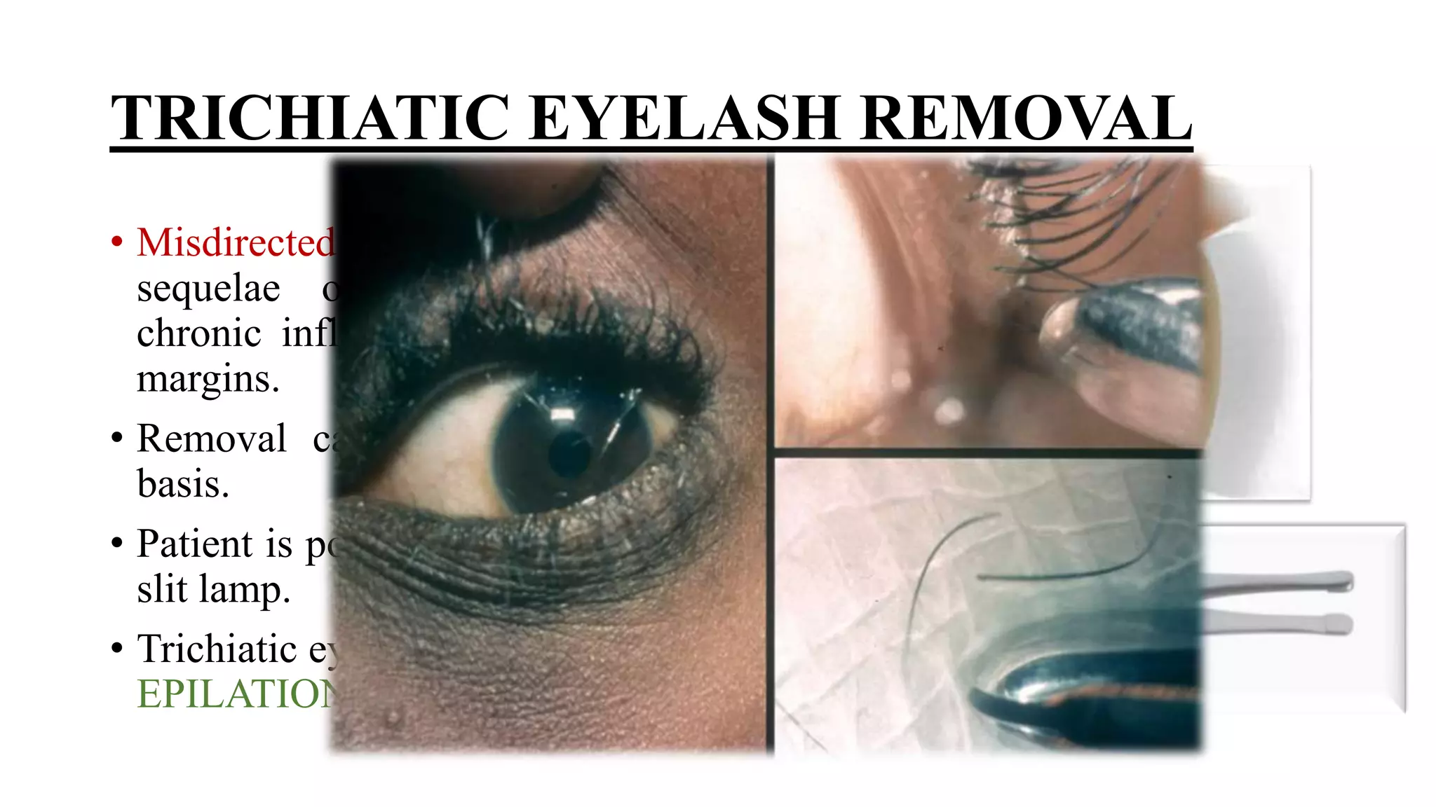 Minor ophthalmic procedures and instruments