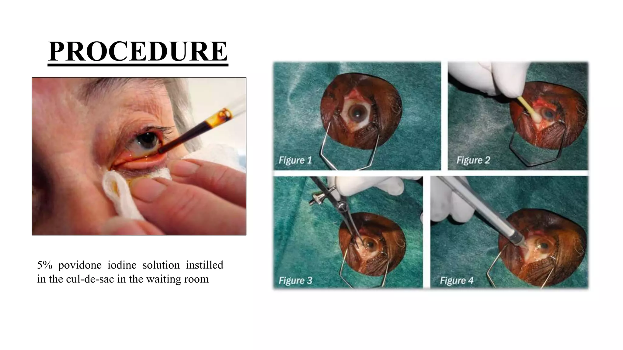 Minor ophthalmic procedures and instruments