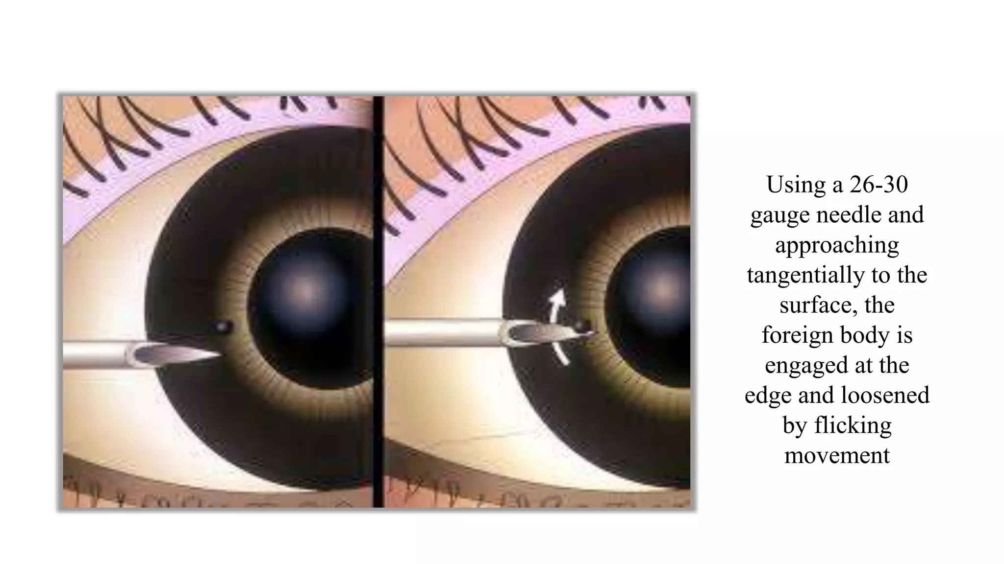 Minor ophthalmic procedures and instruments