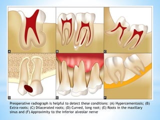 Hypercementosis Roots Radiograph minor oral surgical procedures final.pptx