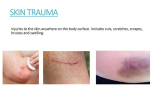 SKIN TRAUMA
Injuries to the skin anywhere on the body surface. Includes cuts, scratches, scrapes,
bruises and swelling.
 