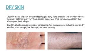 DRY SKIN
Dry skin makes the skin look and feel rough, itchy, flaky or scaly. The location where
these dry patches form vary from person to person. It's a common condition that
affects people of all ages.
Dry skin, also known as xerosis or xeroderma, has many causes, including cold or dry
weather, sun damage, harsh soaps, and overbathing.
 