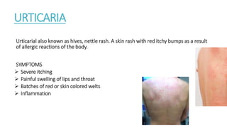 URTICARIA
Urticarial also known as hives, nettle rash. A skin rash with red itchy bumps as a result
of allergic reactions of the body.
SYMPTOMS
 Severe itching
 Painful swelling of lips and throat
 Batches of red or skin colored welts
 Inflammation
 