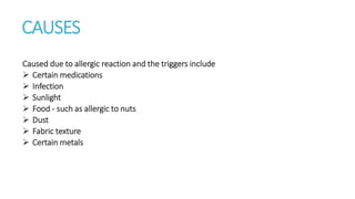 CAUSES
Caused due to allergic reaction and the triggers include
 Certain medications
 Infection
 Sunlight
 Food - such as allergic to nuts
 Dust
 Fabric texture
 Certain metals
 