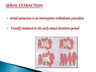 Orthodontic Minor surgery | PPTX