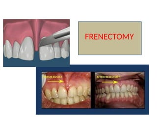Frectomy Minor oral surgical procedure associated with oral surgery | PPTX