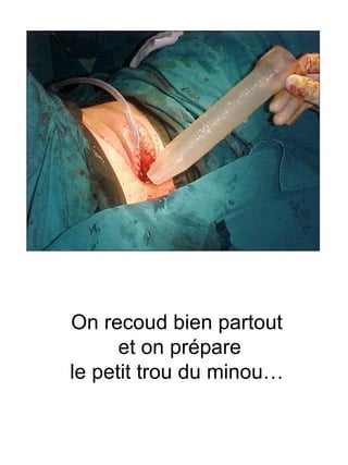 On recoud bien partout  et on prépare le petit trou du minou…  