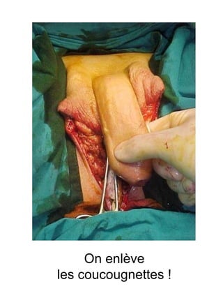 On enlève les coucougnettes ! 