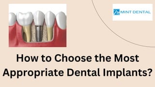 How to Choose the Most
Appropriate Dental Implants?
 