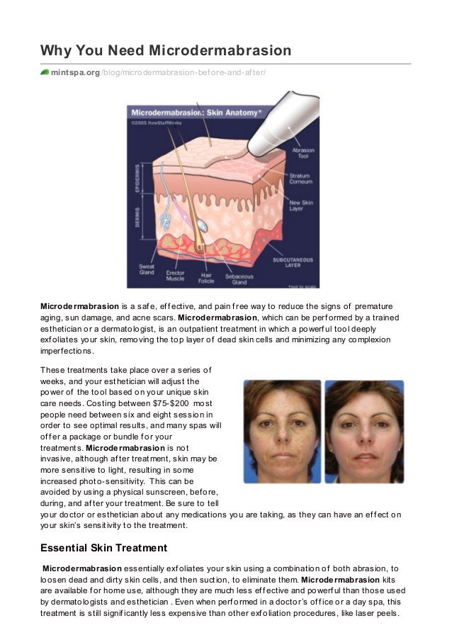 Microdermabrasion Before And After