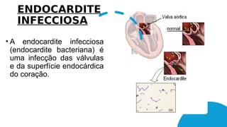 ENDOCARDITE
INFECCIOSA
• A endocardite infecciosa
(endocardite bacteriana) é
uma infecção das válvulas
e da superfície endocárdica
do coração.
 