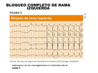BLOQUEO COMPLETO DE RAMA
IZQUIERDA
Los bloqueos de rama tienen características
comunes en el ECG: QRS ensanchado y con
alteración en su configuración e inversión de la
onda T.
•Los bloqueos de rama son retrasos o
defectos en la conducción eléctrica
intraventricular.
 