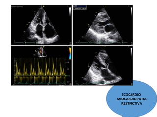 ECOCARDIO
MIOCARDIOPATIA
RESTRICTIVA
 
