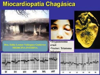 •Trypanosoma
cruzi
•Vector: Triatoma
infestans
Dra. Edda Leonor Velásquez Gutiérrez
MEDICINA INTERNA
 