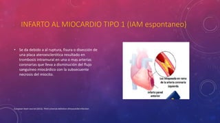 INFARTO AL MIOCARDIO TIPO 1 (IAM espontaneo) 
• Se da debido a al ruptura, fisura o disección de 
una placa ateroesclerótica resultado en 
trombosis intramural en una o mas arterias 
coronarias que lleva a disminución del flujo 
sanguíneo miocárdico con la subsecuente 
necrosis del miocito. 
European Heart Journal (2012), Third universal definition ofmyocardial infarction 
 