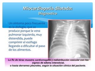 Miocardiopatía dilatada:Miocardiopatía dilatada:
DiagnosticoDiagnostico
∗ Un síntoma poco frecuente
es la disfagia, que se
produce porque la vena
pulmonar izquierda, muy
distendida, puede
comprimir el esófago
llegando a dificultar el paso
de los alimentos.
La Rx de tórax muestra cardiomegalia y redistribución vascular con los
signos de edema intersticial,
o hasta derrames pleurales, según la situación clínica del paciente.
 