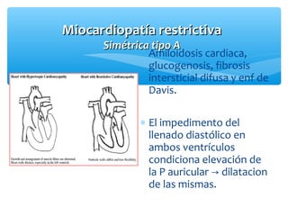Miocardiopatía restrictivaMiocardiopatía restrictiva
Simétrica tipo ASimétrica tipo A
∗ Amiloidosis cardiaca,
glucogenosis, fibrosis
intersticial difusa y enf de
Davis.
∗ El impedimento del
llenado diastólico en
ambos ventrículos
condiciona elevación de
la P auricular dilatacion→
de las mismas.
 