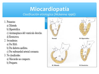 Miocardiopatía
Clasificación etiologica (Mckenna 1996):
 