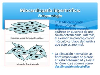 Miocardiopatía hipertrófica:Miocardiopatía hipertrófica:
FisiopatologíaFisiopatología
∗ En la Miocardiopatía
Hipertrófica, el
engrosamiento muscular
aparece en ausencia de una
causa determinada. Además,
el examen microscópico del
músculo cardiaco demuestra
que éste es anormal.
∗ La alineación normal de las
fibras musculares se pierde
en esta enfermedad y a este
fenómeno se conoce como
desalineación miocárdica
 