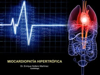 MIOCARDIOPATÍA HIPERTRÓFICA
Dr. Enrique Soltero Martínez
Cardiólogo
 