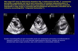 Altri segni ETT sono la disfunzione diastolica VSx, la disfunzione del VDx, il versamento
pericardico (soprattutto nei casi di peri-miocardite, la trombosi endoventricolare, la
pseudo-ipertrofia transitoria delle pareti (espressione dell’edema miocardico presente
soprattutto in fase acuta) e l'aumento dell’ecoriflettenza del miocardio (rilevabile con la
metodica ecocardiografica “integrated backscatter”).
Quadro ecocardiografico di peri-miocardite acuta con versamento pericardico circonferenziale di
spessore massimo 2.6 cm e con parziale organizzazione fibrinica, valutato da sezione
parasternale asse lungo (sinistra), asse corto (centro) e sottocostale (destra).
 