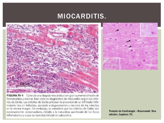 Miocarditis