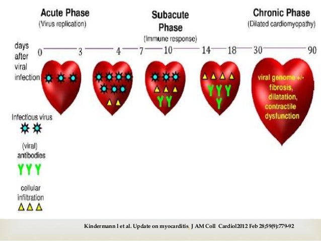 Miocarditis viral